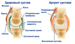 Лечение артрита суставов