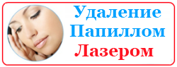 Удаление папиллом лазером
