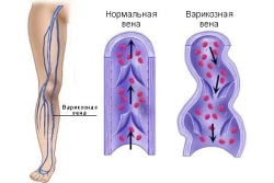 Склерозирование вен нижних конечностей