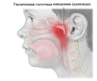 Аденоидит лечение и сиптомы