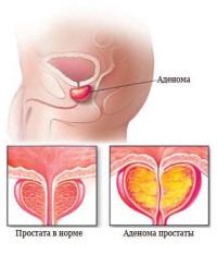 лечение аденомы