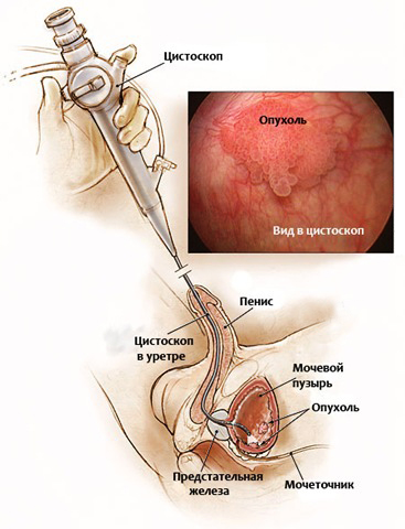 Цистоскопия мочевого пузыря