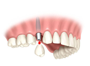 Имплантация зубов