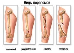 Накостный остеосинтез