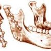 Остеосинтез нижней челюсти
