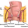 Иссечение свища прямой кишки