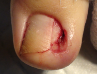 Лечение вросшего ногтя после процедуры